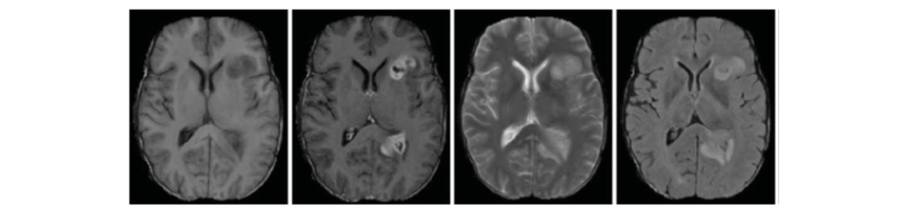 Figure 1.2: A non-trivial classification task for humans. Are you able to spot the tumors? 